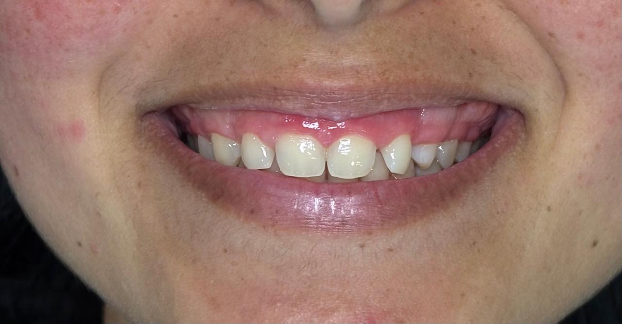 Antes - lentes em resina e plástica gengival