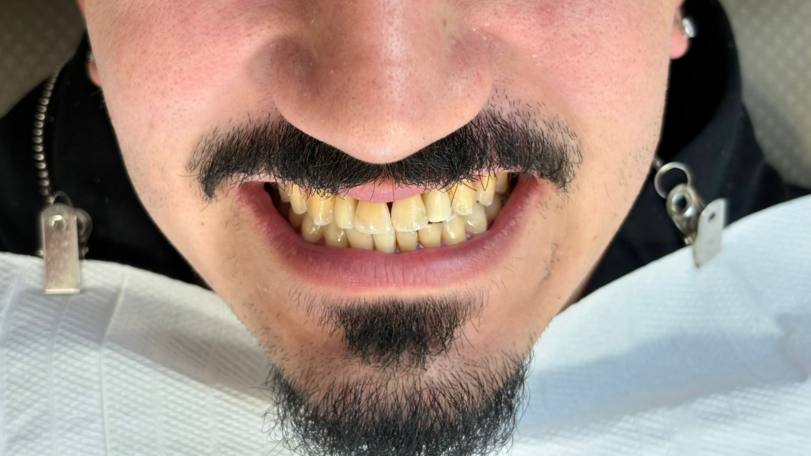 Antes - reabilitação oral estética