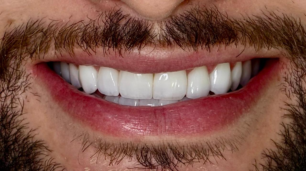 Depois - lentes de porcelana DVO 24 elementos